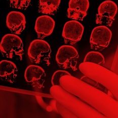 תוצאות בדיקת MRI