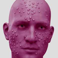 אבעבועות שחורות.Shutterstock אבעבועות שחורות